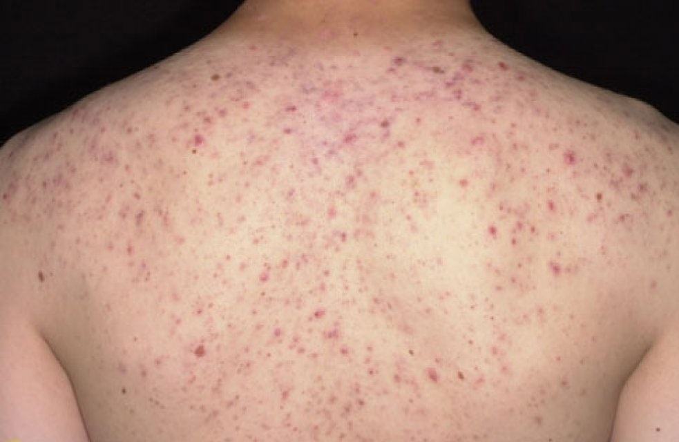 Hình ảnh mụn lưng