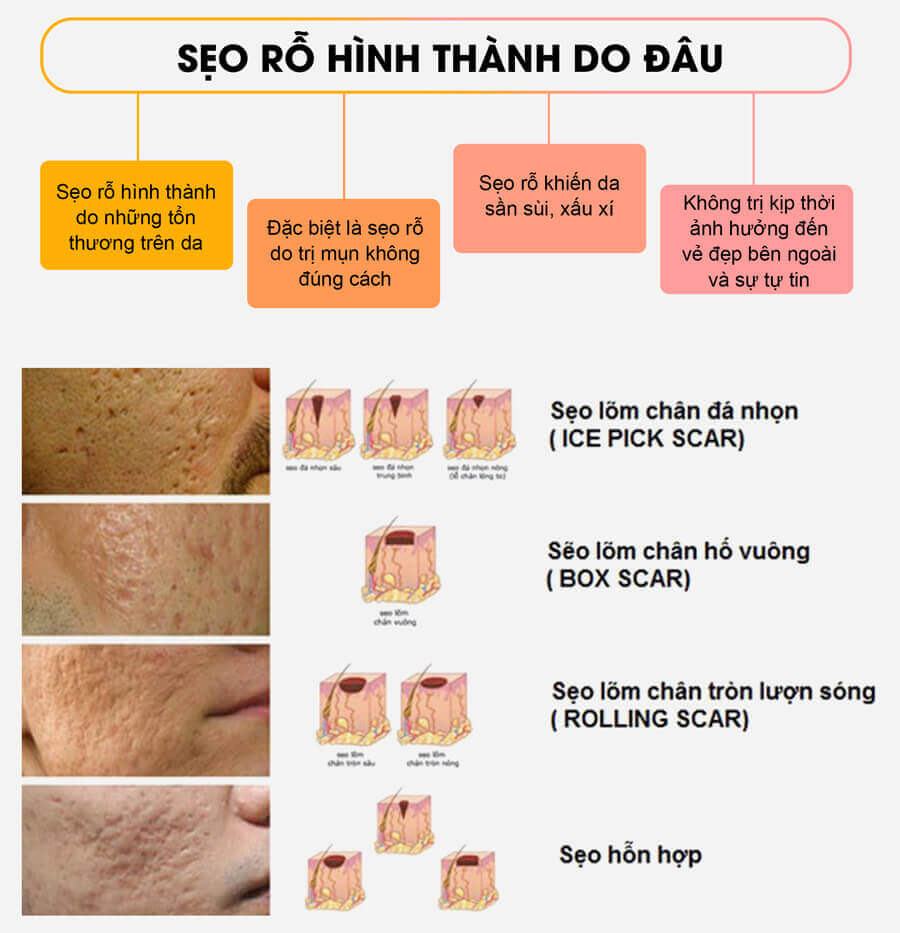 Nguyên nhân hình thành sẹo rỗ