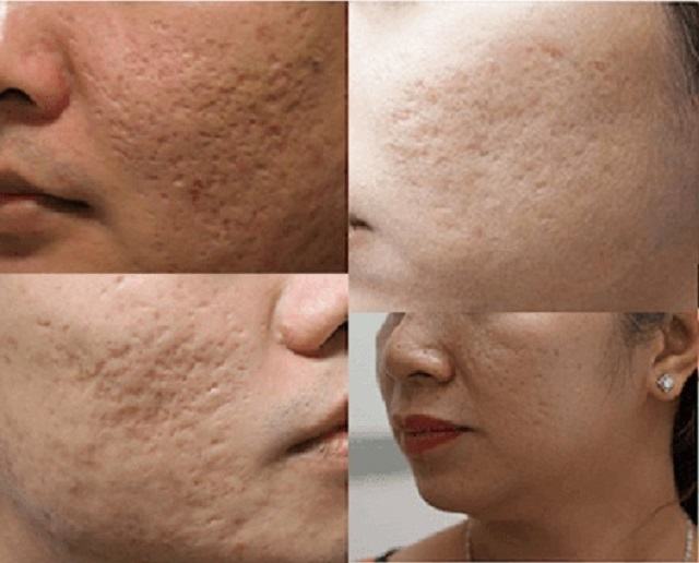 Hình ảnh sẹo rỗ mụn