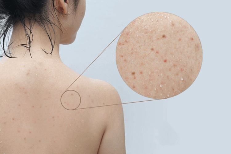 Hình ảnh mụn lưng