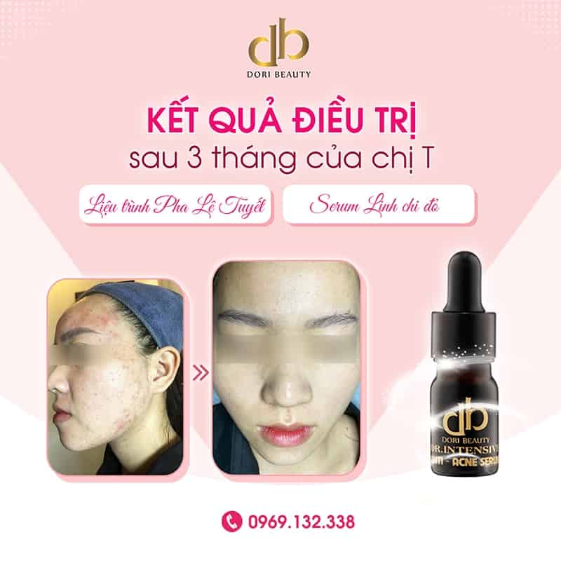 Kết Quả Trị Mụn: Liệu Trình Pha Lê Tuyết & Serum Linh Chi Đỏ