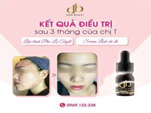 Liệu trình pha lê tuyết, serum linh chi đỏ: trị mụn