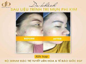 Sau Điều Trị Phi Kim Với Serum Tuyết Liên Hoa & Tế Bào Gốc