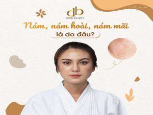 Tại Sao Điều Trị Nám Mãi Mà Không Hết