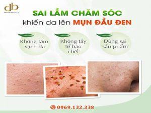 Top 3 Sai Lầm Chăm Sóc Khiến Da Bị Mụn Đầu Đen