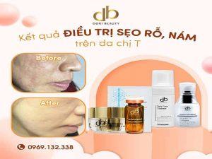 Hiệu Quả Trị Sẹo Rỗ Phi Kim Với Tế Bào Gốc EGF Trên Da