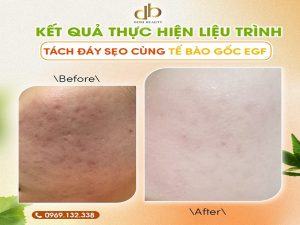 Hình Ảnh Sau Liệu Trình Tách Đáy Sẹo Với Tế Bào Gốc EGF