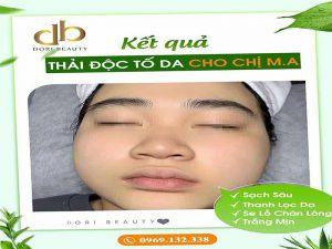 Kết Quả Thải Độc Tố Da Cho Chị M.A