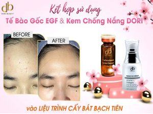 Kết Hợp Sử Dụng Tế Bào Gốc Egf Và Kem Chống Nắng Dori Vào Liệu Trình Cấy Bát Bạch Tiên.