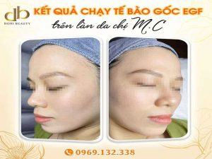 Hình Ảnh Chạy Tế Bào Gốc EGF Trên Làn Da Chị M.C