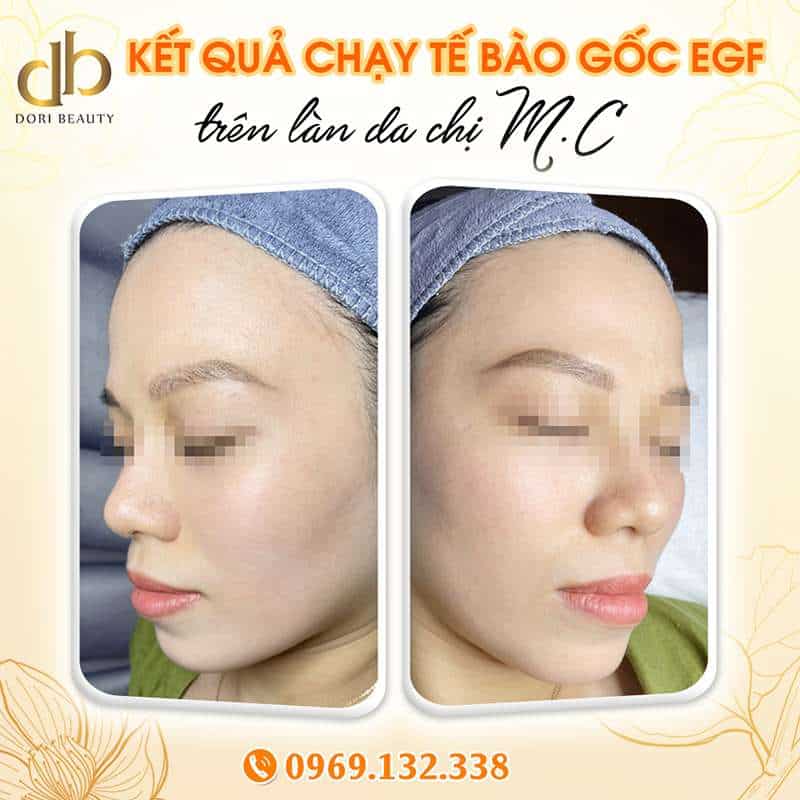 Hình Ảnh Chạy Tế Bào Gốc EGF Trên Làn Da Chị M.C