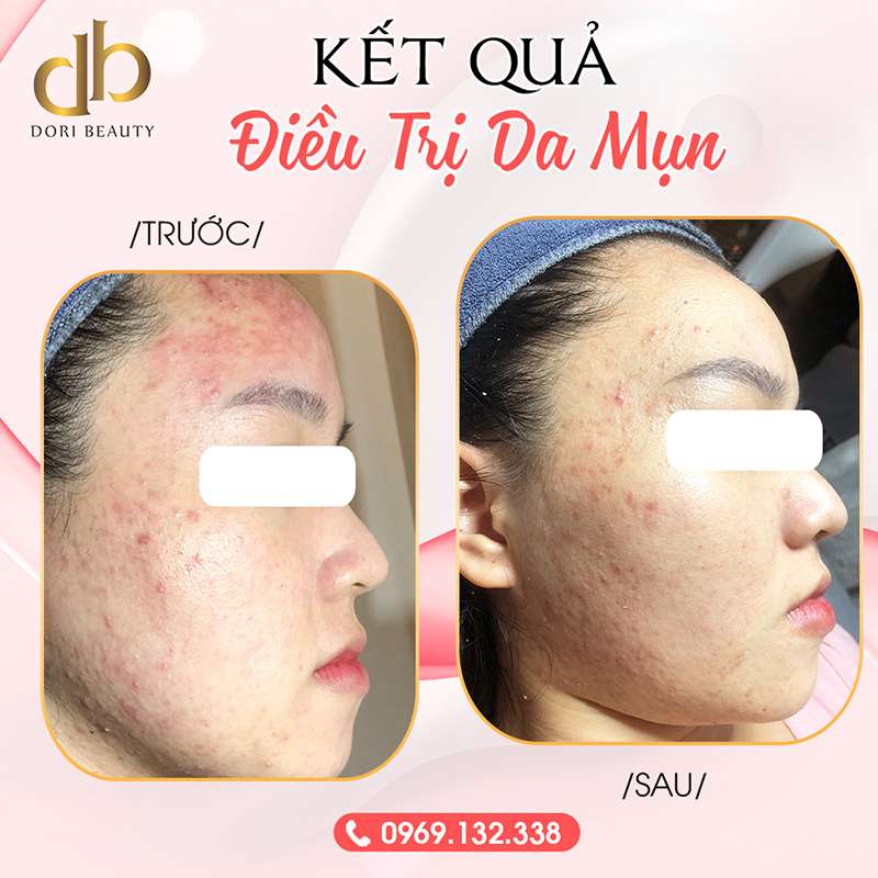Trước và sau khi điều trị mụn