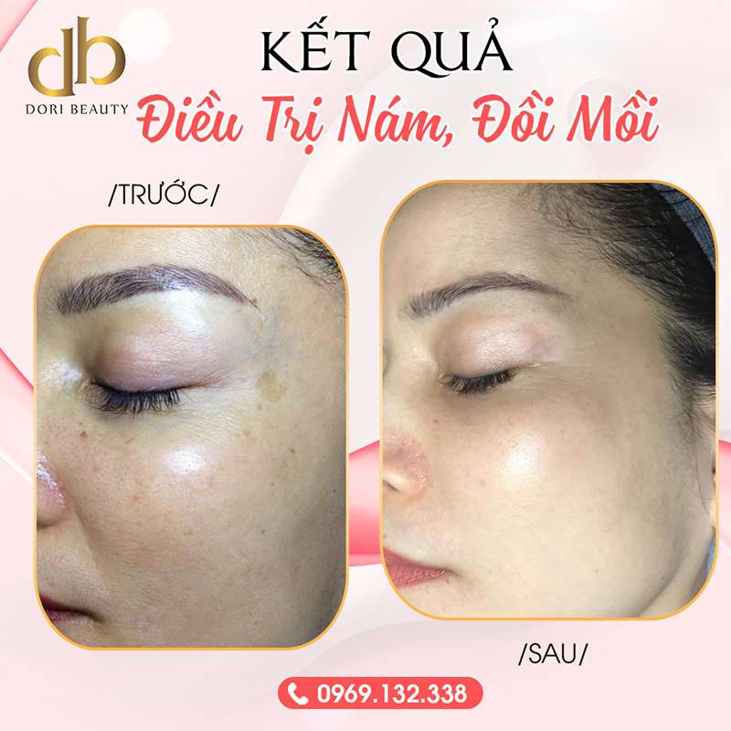 Trước và sau khi điều trị nám, đồi mồi