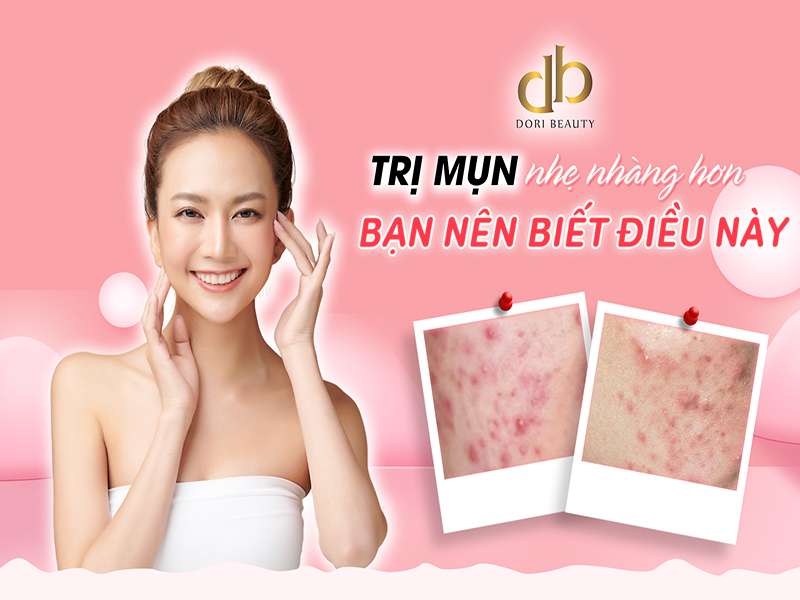 Trị Mụn Nhẹ Nhàng Hơn Nếu Bạn Biết Những Điều Này